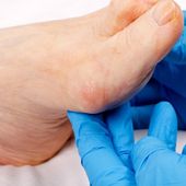 Ogni passo conta: un incontro per proteggere i piedi dal diabete