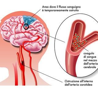 In Valle 200 nuovi casi di ictus ogni anno