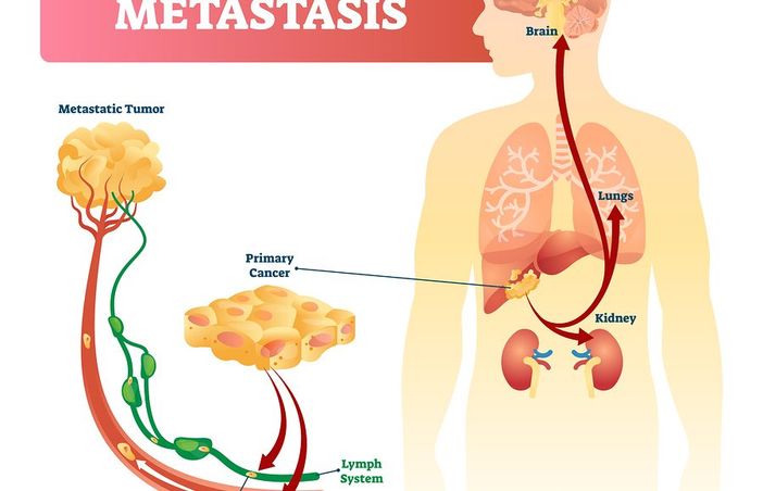 Ad Aosta la prima 'Panchina per la vita' contro il tumore metastatico