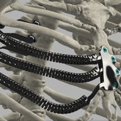 Chirurgia ad altissima complessità al 'Parini', asportato tumore di 20 cm e ricostruita parete toracica Chirurgia ad altissima complessità al 'Parini', asportato tumore di 20 cm e ricostruita parete toracica