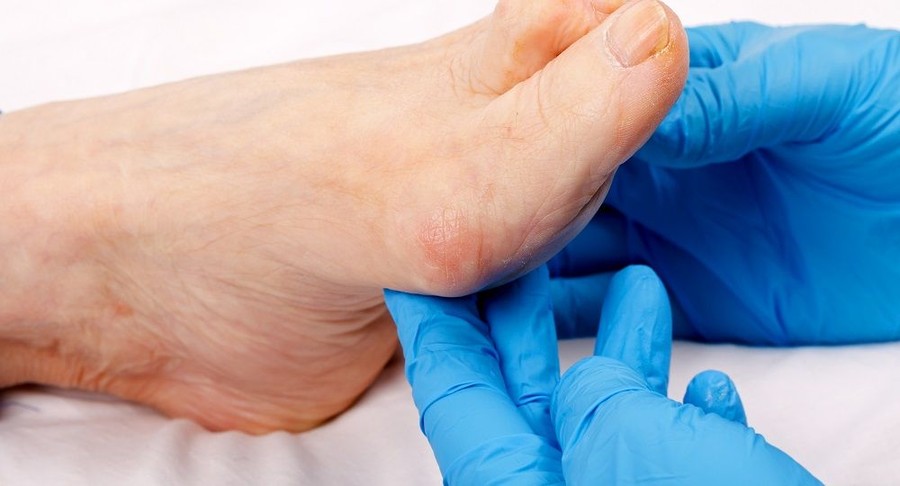 Ogni passo conta: un incontro per proteggere i piedi dal diabete